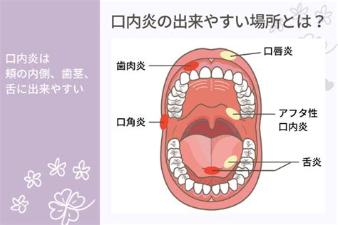 口穴|【口内炎】はなぜできる？原因や種類できてしまった。